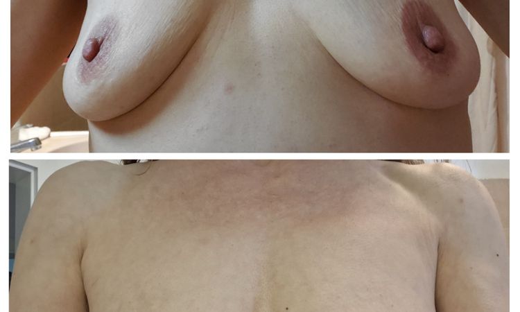 Zweite  Eigenfettbehandlung / Brust sinnvoll nach Fettverlust nach erstem FT? - 71195