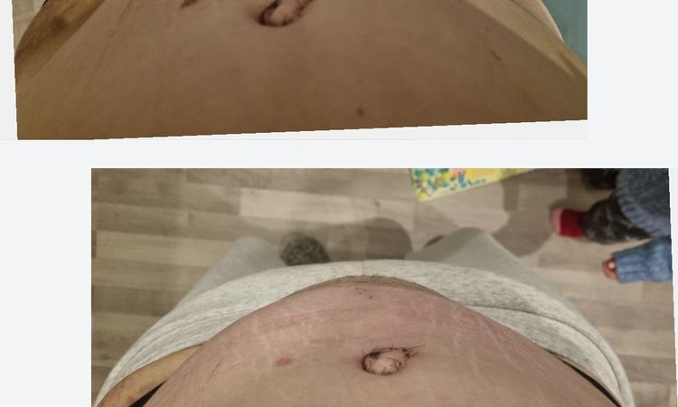 Wulstige Schwellung über Narbe halten nach 6 Wochen an. - 71223