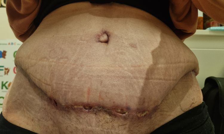 Wulstige Schwellung über Narbe halten nach 6 Wochen an. - 71224