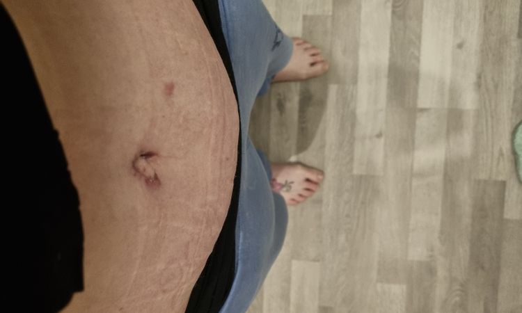Wulstige Schwellung über Narbe halten nach 6 Wochen an. - 71225