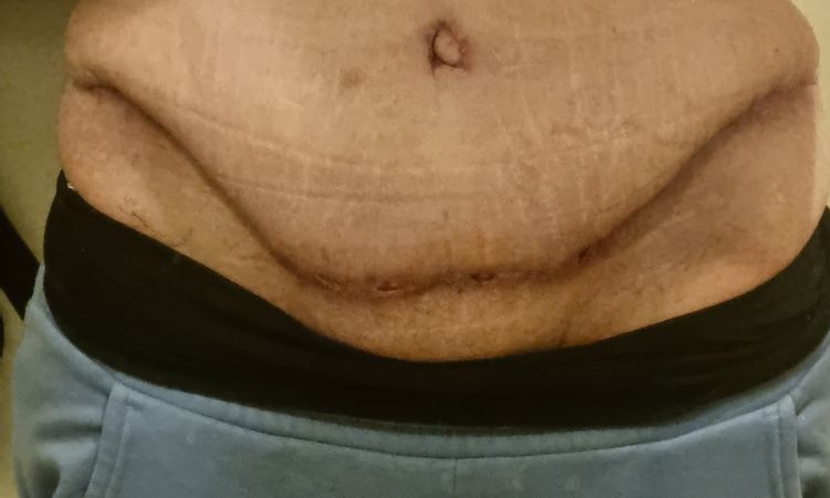 Wulstige Schwellung über Narbe halten nach 6 Wochen an. - 71226