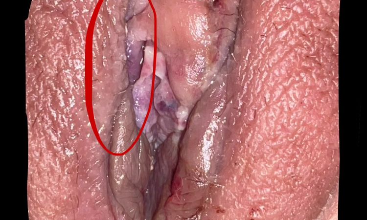 Angst nach Schamlippenverkleinerung - 71244
