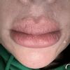 Warum ist meine Lippe so nach hylase - 71265
