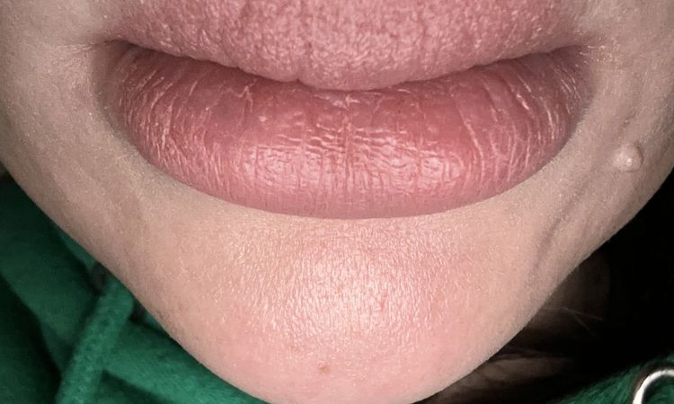 Warum ist meine Lippe so nach hylase - 71265