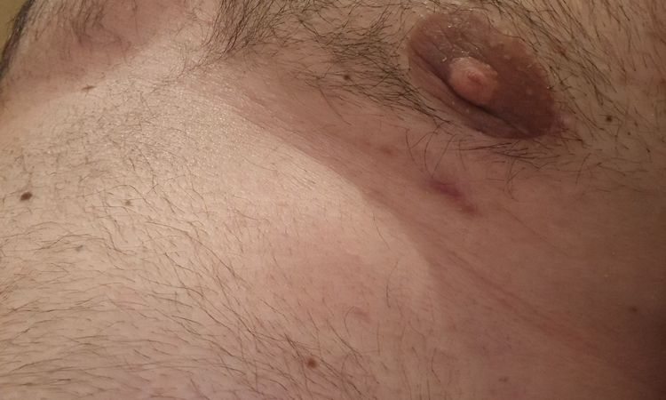 Nach Gynäkomastie Op ist Aerola immer noch groß - 71488