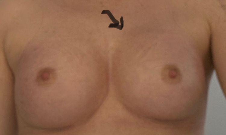 6 1/2 Wochen Post OP eine Brust etwas höher - 71559