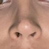 Halses oder Kristallkortison in die Nase