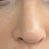 Halses oder Kristallkortison in die Nase - 71622
