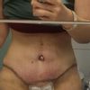 Nachstraffen des Bauches mit Liposuktion der Hüften