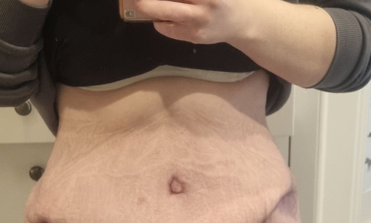 Nachstraffen des Bauches mit Liposuktion der Hüften - 71663
