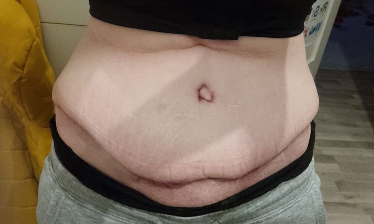 Nachstraffen des Bauches mit Liposuktion der Hüften - 71665