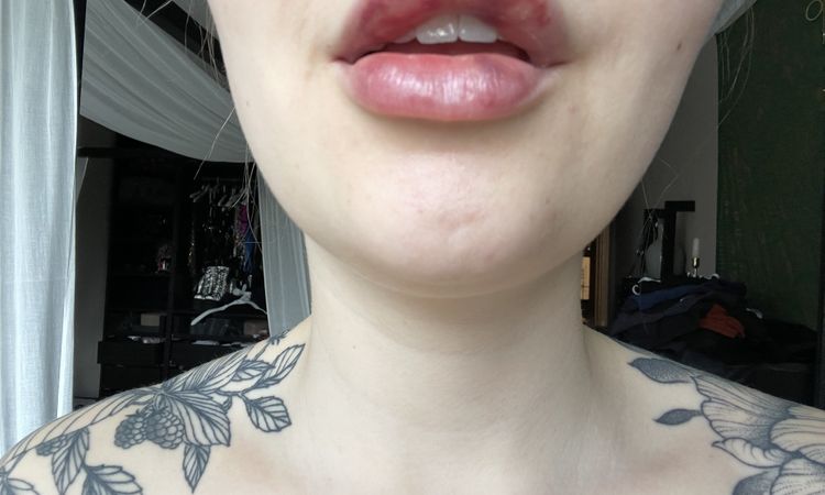 Nach Lippen aufspritzen Asymmetrie - 71721