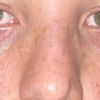 Nase nach 1 Jahr Nasenop immernoch angeschwollen - 71802