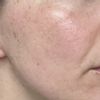 Narben und große Poren im Wangenbereich. Welche Behandlung empfiehlt sich? - 71858