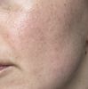 Narben und große Poren im Wangenbereich. Welche Behandlung empfiehlt sich? - 71859