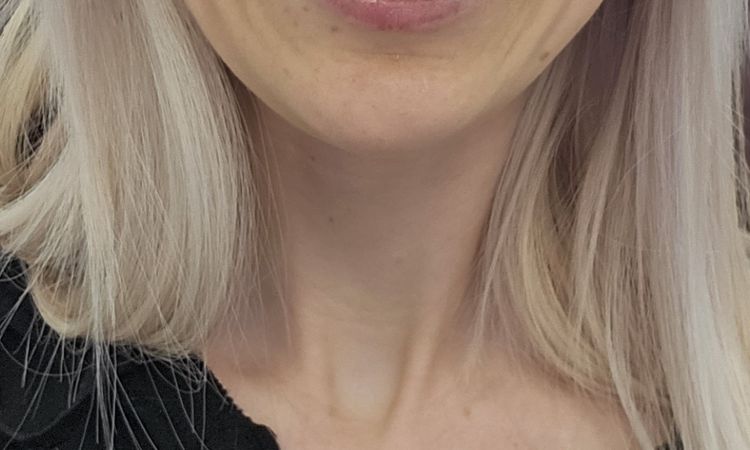 Hyaluron oder Facelift? - 71902