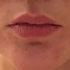 Möglichkeiten der Lippenvergrößerung