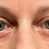 Asymmetrische Augen nach Ober- und Unterlidstraffung - 71935