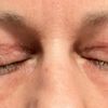 Asymmetrische Augen nach Ober- und Unterlidstraffung - 71936