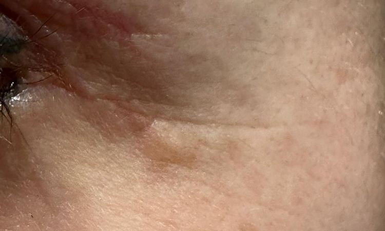 Seitliche Knubbel nach Ober und Unterlidstraffung - 72082