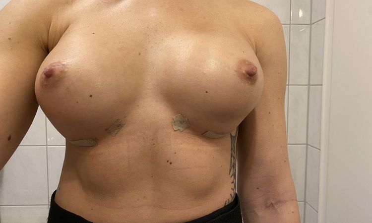 Doppelte Brustfalte nach 1,5 Wochen post OP - 72250