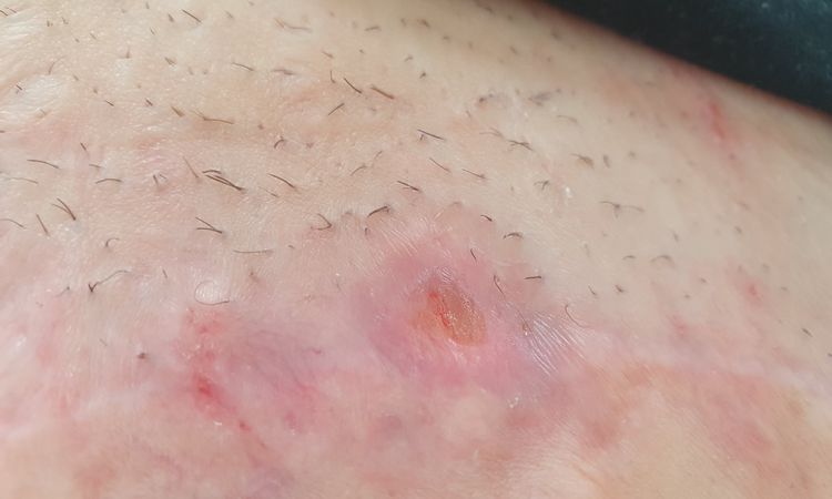 Abszess nach Bauchdeckenstraffung - 72255