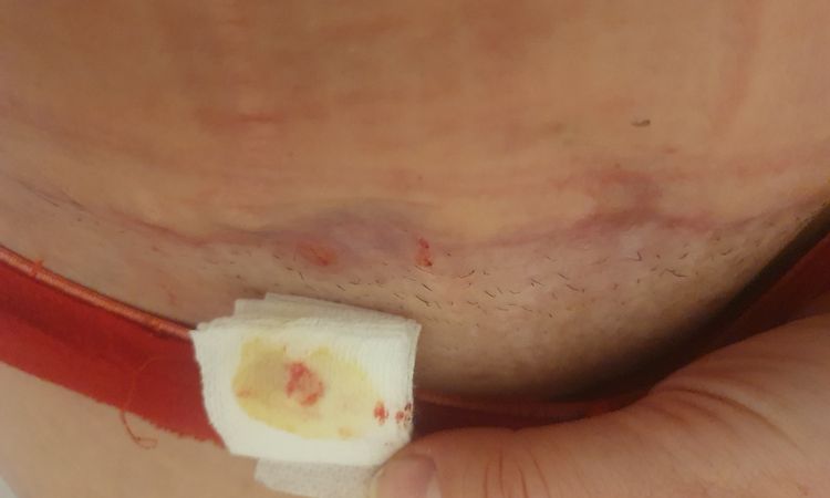 Abszess nach Bauchdeckenstraffung - 72256