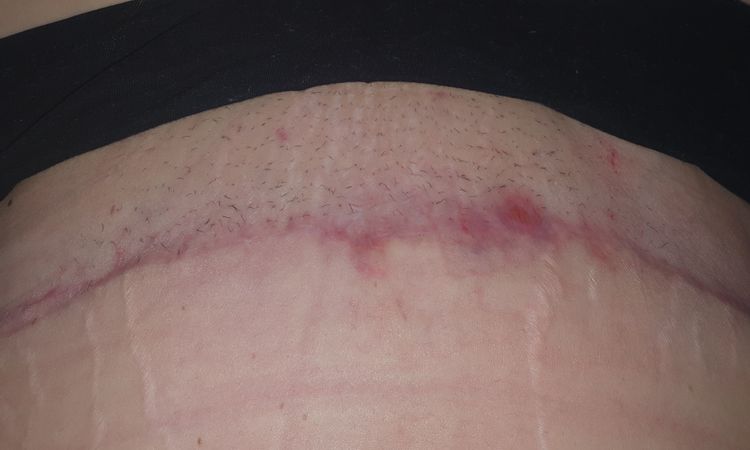 Abszess nach Bauchdeckenstraffung - 72257