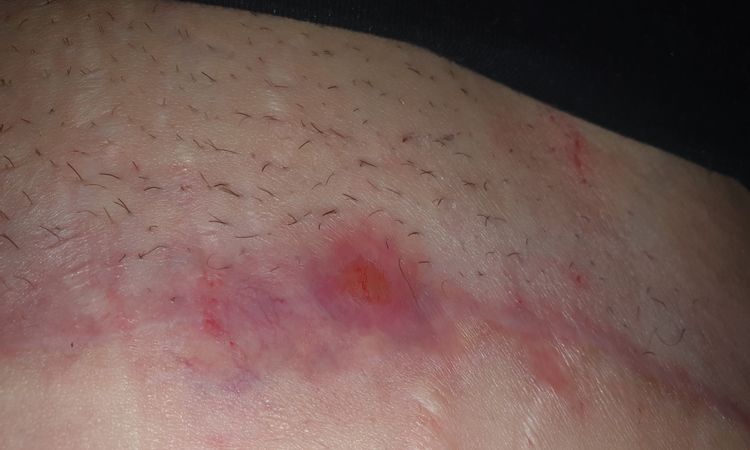 Abszess nach Bauchdeckenstraffung - 72258