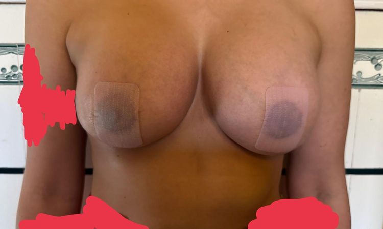 Ringstraffung mit Implantat verformt und ungleich - 72290