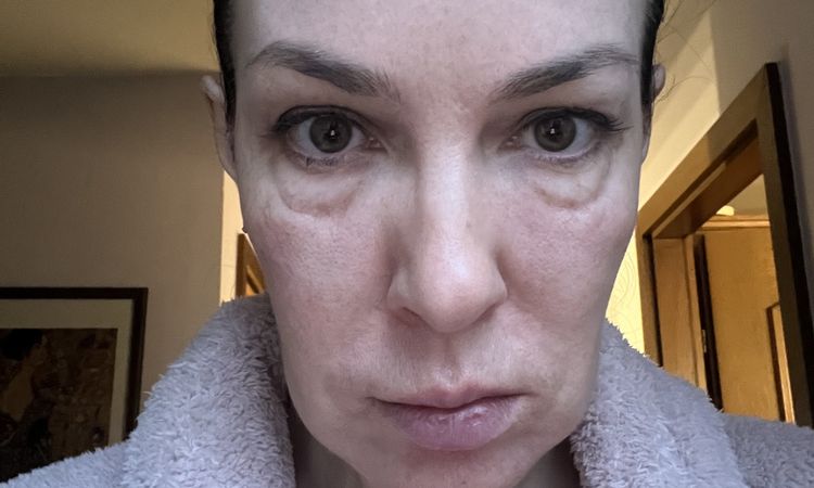 Stark geschwollene Augen nach Sculptra - 72443