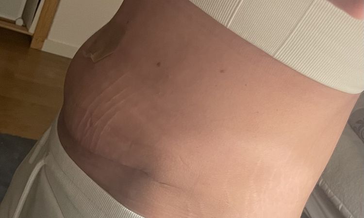 Wie erkenne ich Serom nach Bauchdeckenstraffung - 72642