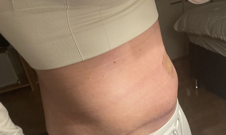 Wie erkenne ich Serom nach Bauchdeckenstraffung - 72643
