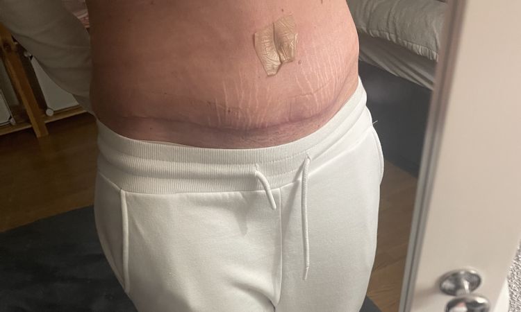 Wie erkenne ich Serom nach Bauchdeckenstraffung - 72644
