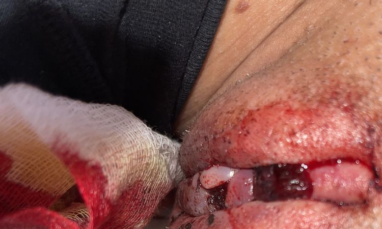 Schamlippenverkleinerung und nun Blutfetzen - 72806