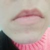 Talgdrüsen auf Lippe/Mund