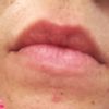 Talgdrüsen auf Lippe/Mund