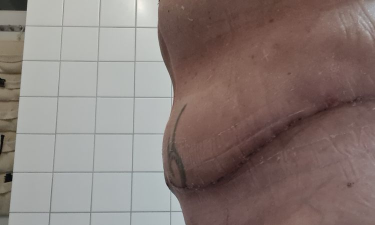 Bauchdeckenstraffung 2,5 Wochen post OP - 73247