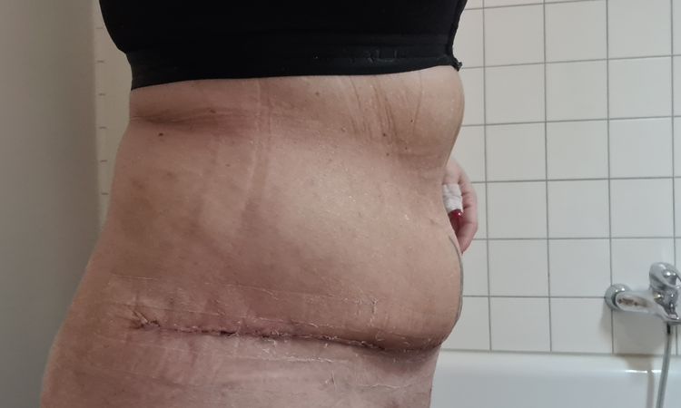 Bauchdeckenstraffung 2,5 Wochen post OP - 73249