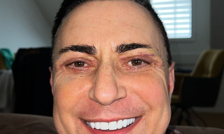 12 Tage Post Op Augenlidstraffung - 73301