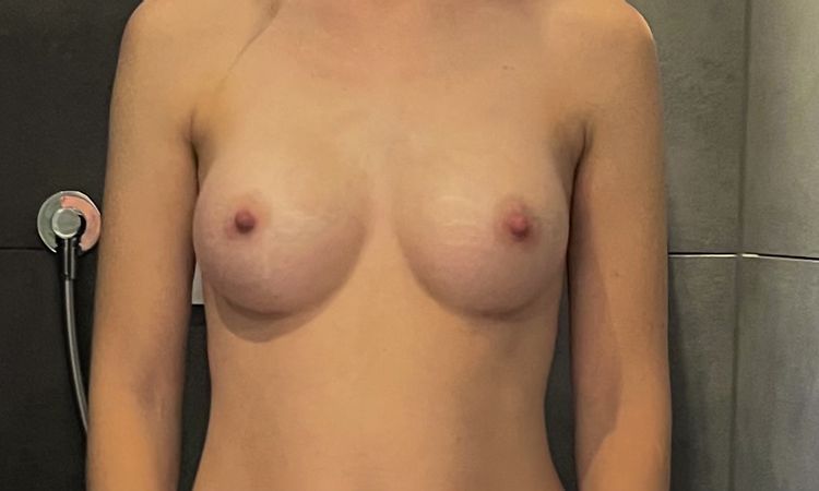 4 Monate post OP - leichter Größenunterschied normal? - 73315