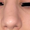 Nasenrücken schief nach Nasen-Op