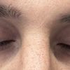 Augen asymmetrisch (Oberlider faltig) - 73338