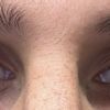 Augen asymmetrisch (Oberlider faltig) - 73339