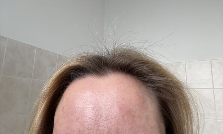 Ist diese Schwellung nach Botox normal? - 73346