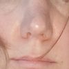 Kann eine Nase nach Kristall-Kortison Injektion noch operiert werden? - 73470