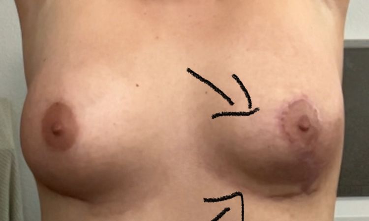 Ungleiche Brust nach Bruststraffung - 73478