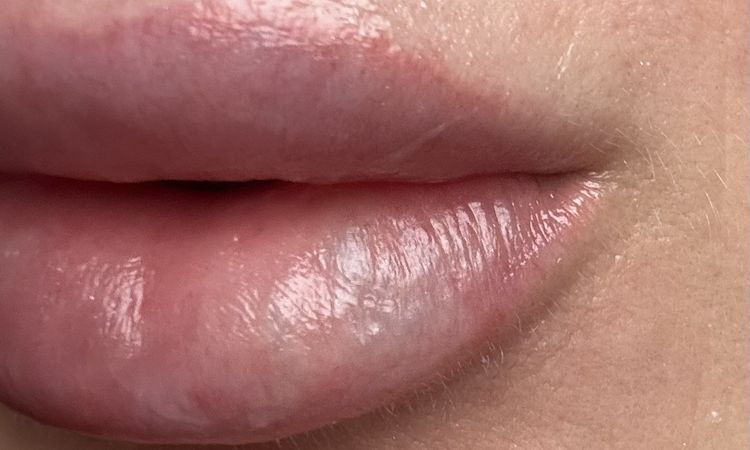 Weiß-blaue Lippe nach Lippen aufspritzen nach 2 Wochen - 73529