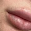 Weiß-blaue Lippe nach Lippen aufspritzen nach 2 Wochen - 73530
