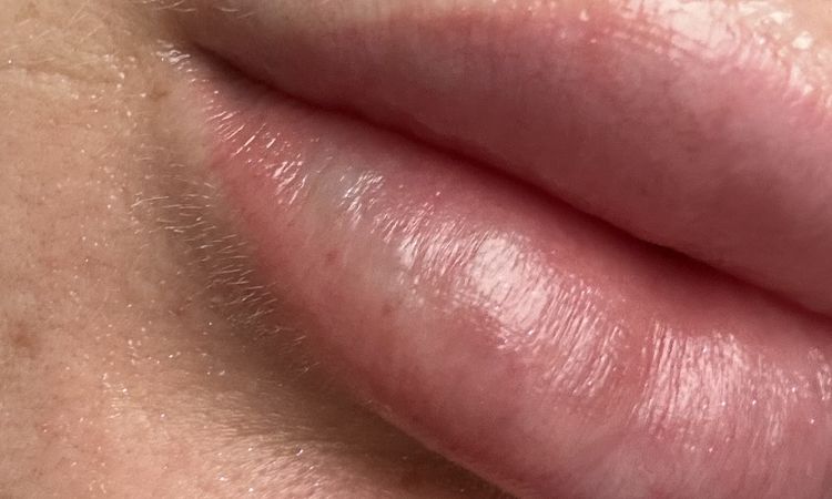 Weiß-blaue Lippe nach Lippen aufspritzen nach 2 Wochen - 73530